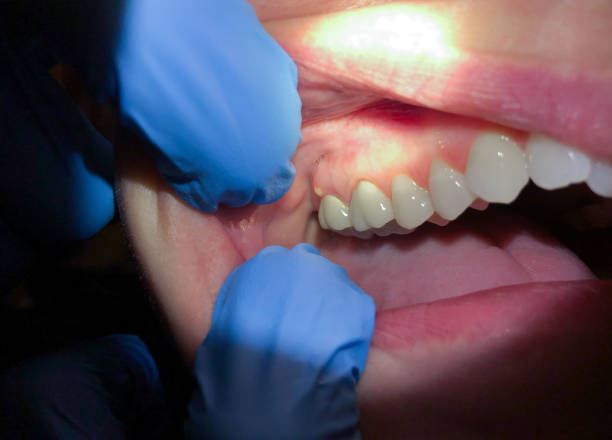 Best Emergency Tooth Extraction in Dry Ridge, OH